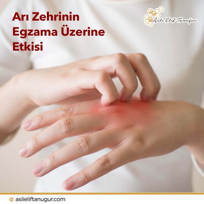 ari_zehrinin_egzama_uzerine_etkisi